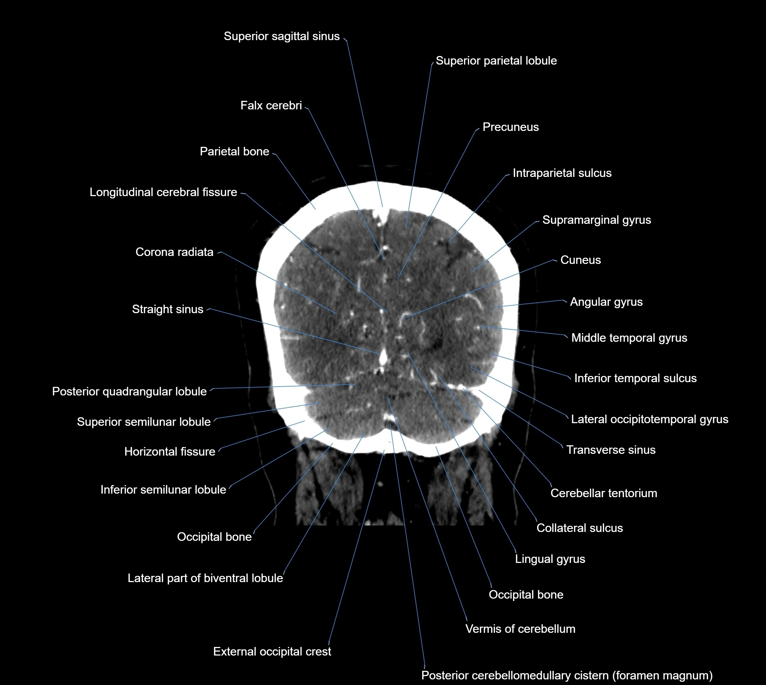 CT Brain coronal cross sectional radiology anatomy image  -img-00001-038.webp